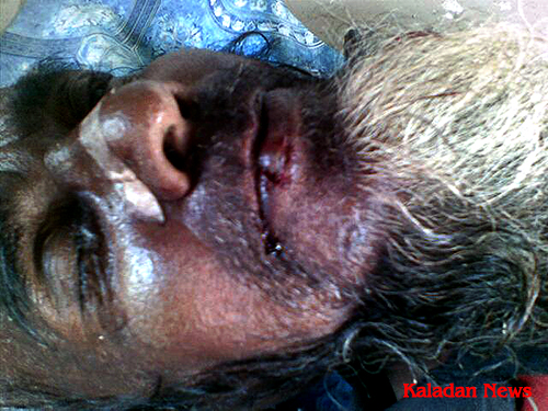 Hussein, a Rohingya beggar died in hospital after being beaten by police.