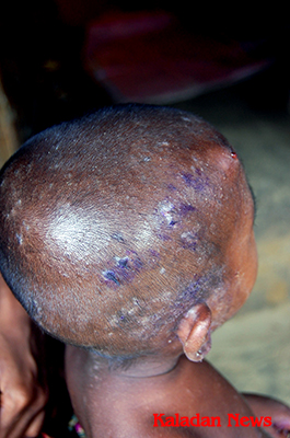 Refugee child with skin diseases