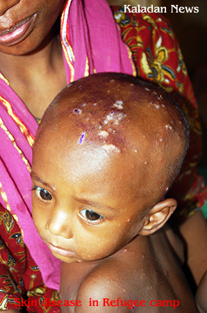 A refugee child with a skin disease.