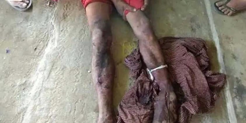 Photo -The landmine blast victim from Ye Phyu Township (MNA)