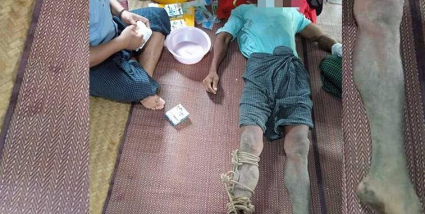 Internally displaced people (IDPs) from Zaw Chaung Village in Kanbalu Township, Sagaing Region, receive treatment for snakebites. (Photo: Kyunhla Activists Group)