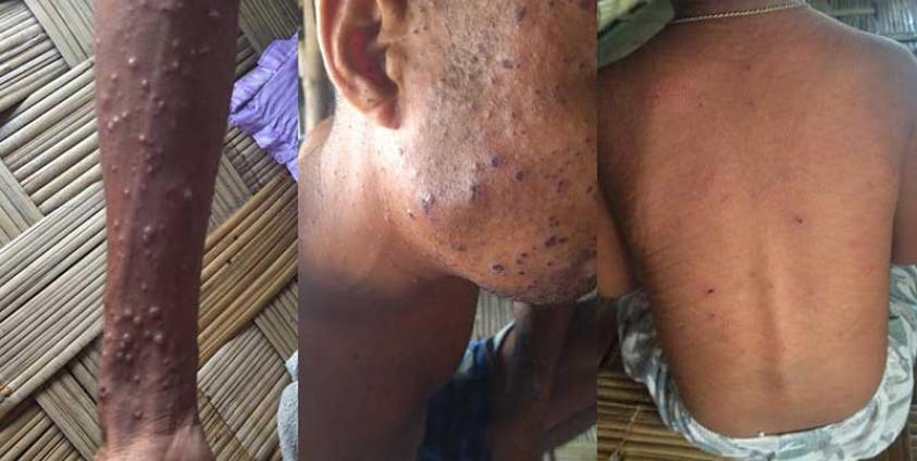 Several people are afflicted with skin conditions in Kyauktaw Township’s Nyaungchaung IDP camp. (Photo: CJ)