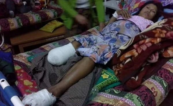 Photo by SHRF- Nang Khin Than Nu was injured by Burmese army air strike.