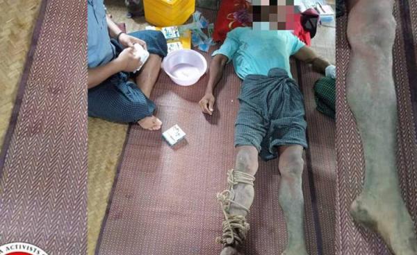 Internally displaced people (IDPs) from Zaw Chaung Village in Kanbalu Township, Sagaing Region, receive treatment for snakebites. (Photo: Kyunhla Activists Group)