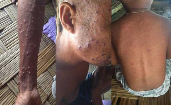 Several people are afflicted with skin conditions in Kyauktaw Township’s Nyaungchaung IDP camp. (Photo: CJ)